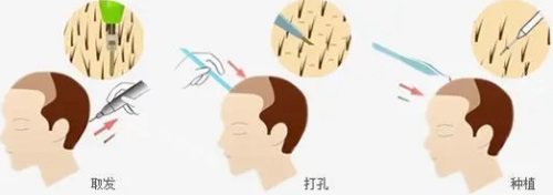 植發(fā)過程圖