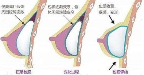 包膜挛缩过程