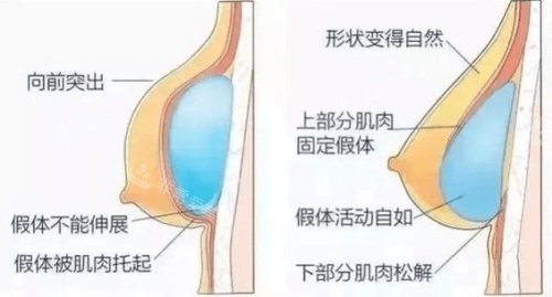 隆胸后假體變化示意圖 隆胸后假體變化示意圖