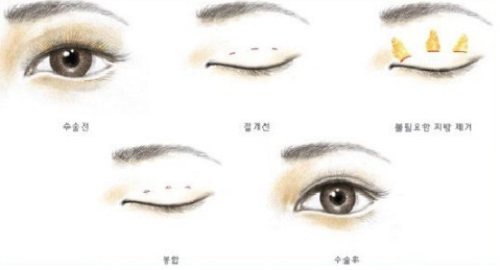 雙眼皮手術(shù)示意圖 雙眼皮手術(shù)示意圖