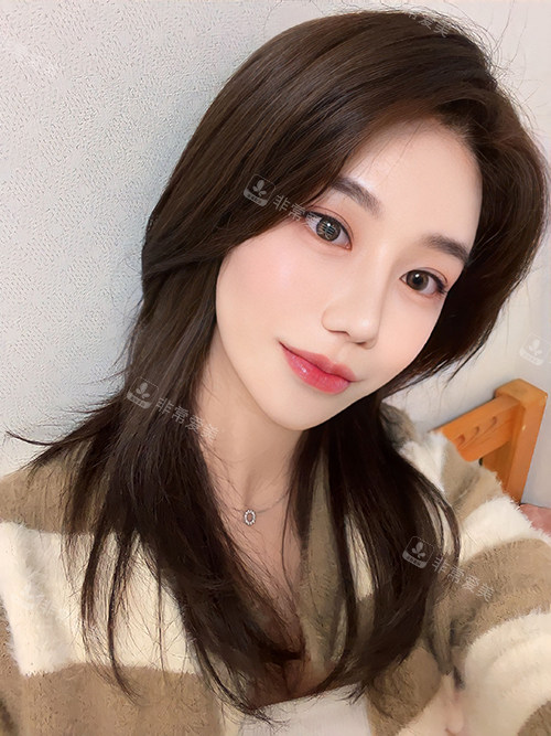 韩国乐日整形鼻修复手术后 韩国乐日整形鼻修复手术后