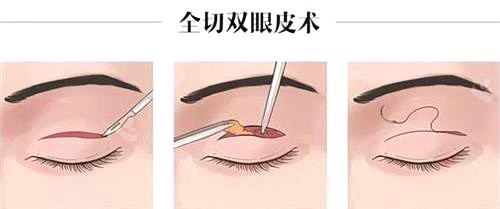 新疆整形醫(yī)院眼部整形圖 新疆整形醫(yī)院眼部整形圖