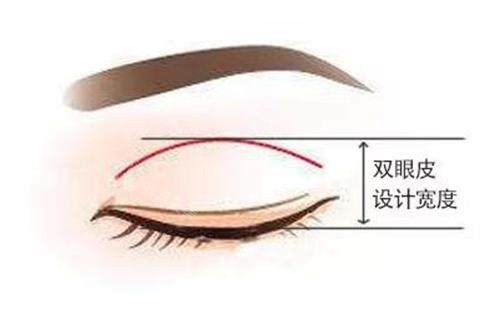 新疆整形醫(yī)院雙眼皮示意圖 新疆整形醫(yī)院雙眼皮示意圖