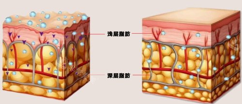 新疆整形医院吸脂脂肪图