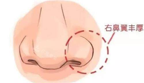 合肥華美整形醫(yī)院鼻部整形示意圖