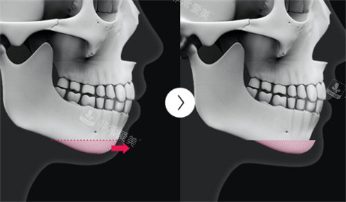 下巴截骨前移