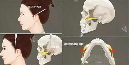 截骨卡通示意图