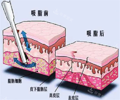 吸脂前后皮肤内部变化说明图