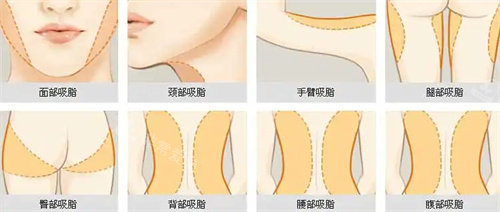 吸脂适用的部位展示图 吸脂适用的部位展示图