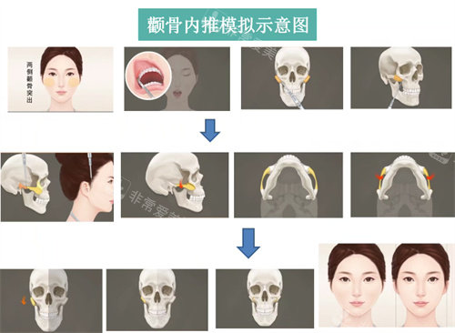 朱乐林医生磨骨过程图