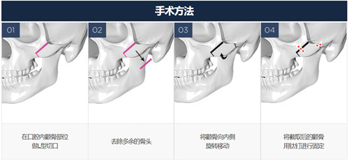 韩国GNG整形外科颧骨整形手术方式
