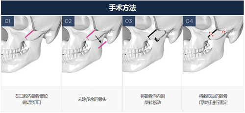 韩国改脸型手术医院哪家好?看过GNG整形磨骨日记超心动！