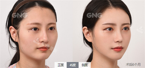 韩国GNG整形外科磨骨对比图