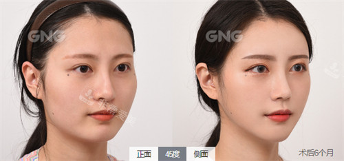 韓國(guó)GNG整形外科磨骨對(duì)比圖 韓國(guó)GNG整形外科磨骨對(duì)比圖