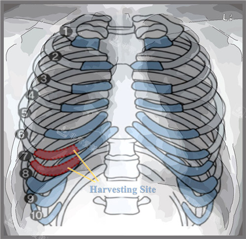 隆鼻手术中取肋骨的位置
