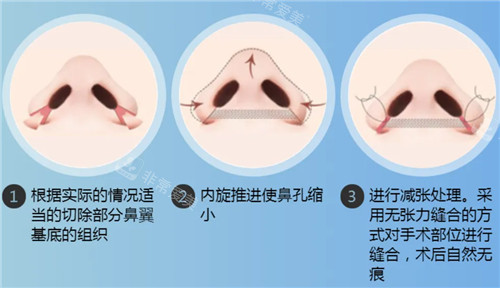 鼻翼缩小手术方法展示