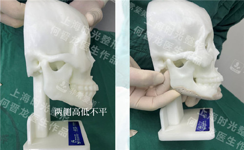 上海時(shí)光整形外科Peek材料修復(fù)下頜角 上海時(shí)光整形外科Peek材料修復(fù)下頜角