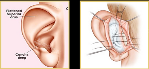 耳朵手术图示