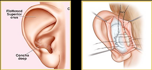 耳朵手術(shù)圖示