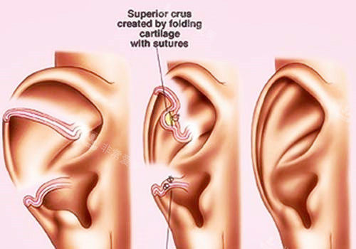 外耳手术图示