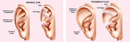 耳朵整形手术图示