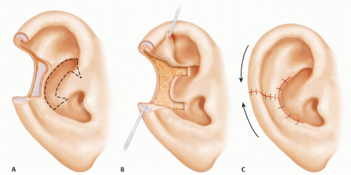 耳朵修复手术图示