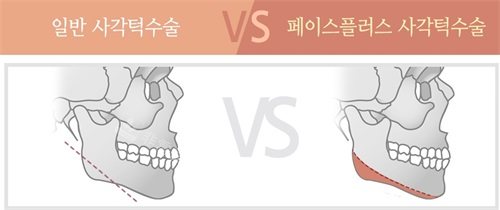 韩国Faceplus整形医院普通下颌角截骨对比长曲线下颌角截骨