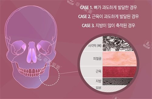 韓國Faceplus整形醫(yī)院下頜角手術的不同情況