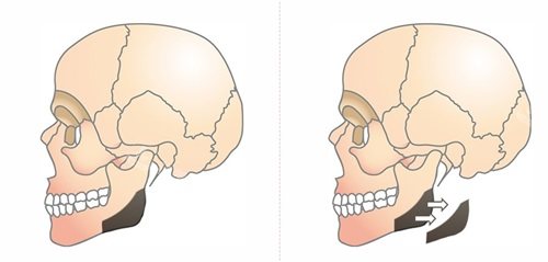 韩国Faceplus整形医院下颌角皮质骨手术示意图