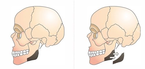 韓國Faceplus整形醫(yī)院下頜角皮質骨手術示意圖