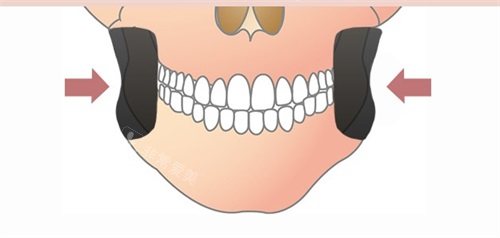 韩国Faceplus整形医院下颌角咬肌位置示意图