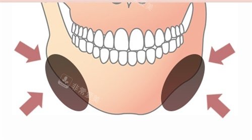 韩国Faceplus整形医院下颌角脂肪问题示意图