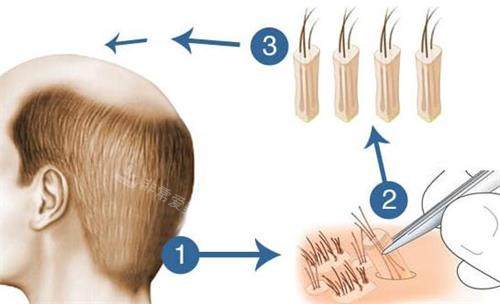 新疆整形医院植发示意图