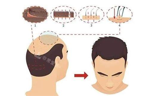 新疆整形医院植发步骤图
