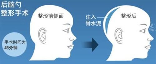 后脑勺整形前后对比图