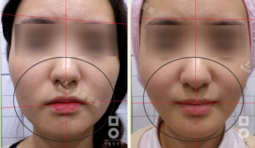 韩国美尔韩医院女性面部不对称