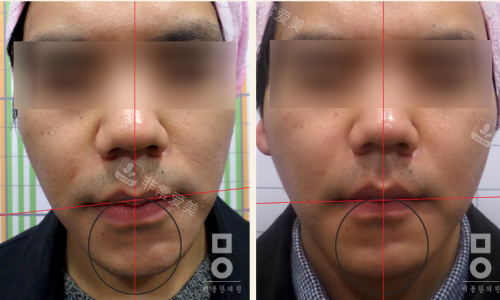 韩国美尔韩医院不对称面部不对称