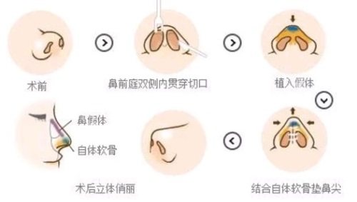 鼻整形過程示意圖 鼻整形過程示意圖