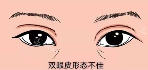 雙眼皮形態(tài)不佳 雙眼皮形態(tài)不佳