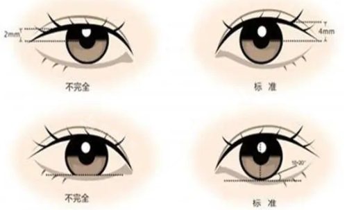 標(biāo)準(zhǔn)的眼睛形態(tài) 標(biāo)準(zhǔn)的眼睛形態(tài)