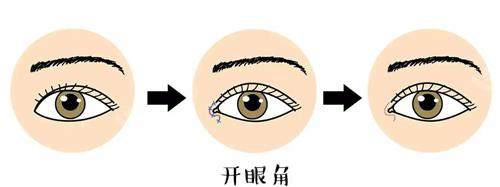 韓國來麗整形外科眼角示意圖