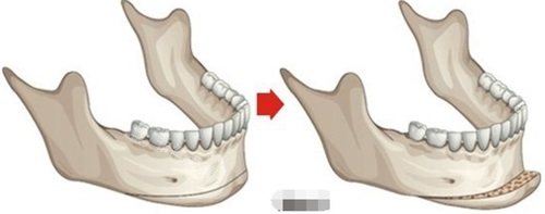 下巴截骨手术示意图