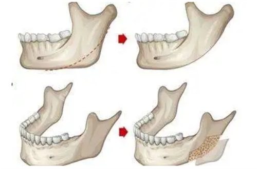 下颌角整形示意图