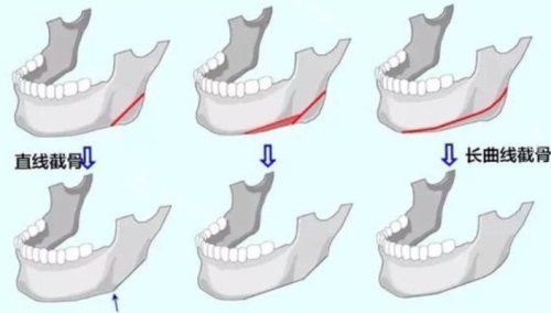 长曲线截骨示意图