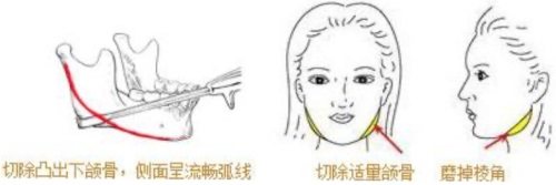 下頜角切除示意圖 下頜角切除示意圖