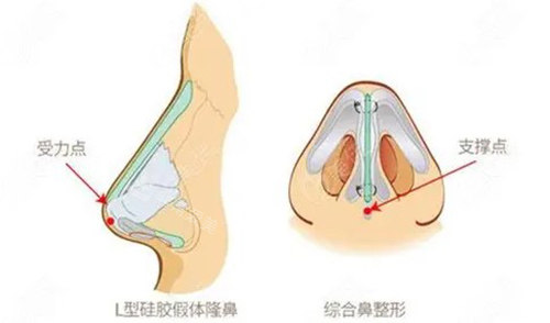 隆鼻手术示意图