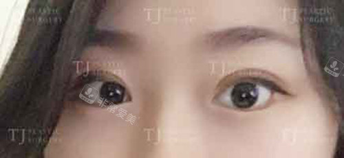 韓國(guó)TJ整形外科眼整形術(shù)后 韓國(guó)TJ整形外科眼整形術(shù)后