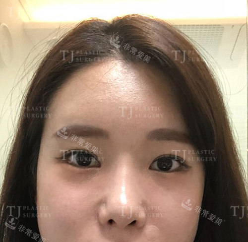 韩国TJ整形外科眼鼻整形术前