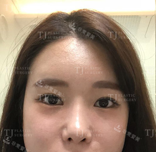 韓國TJ整形外科眼鼻整形術(shù)前 韓國TJ整形外科眼鼻整形術(shù)前