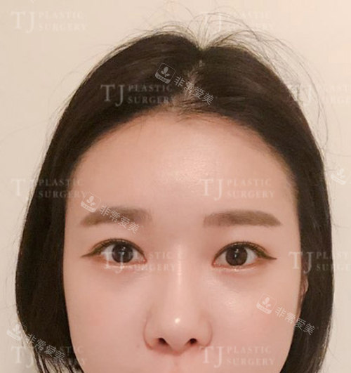 韓國TJ整形外科眼鼻整形術(shù)后 韓國TJ整形外科眼鼻整形術(shù)后